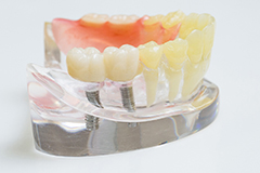 セラミック治療