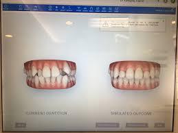 矯正治療後の歯並びを確認